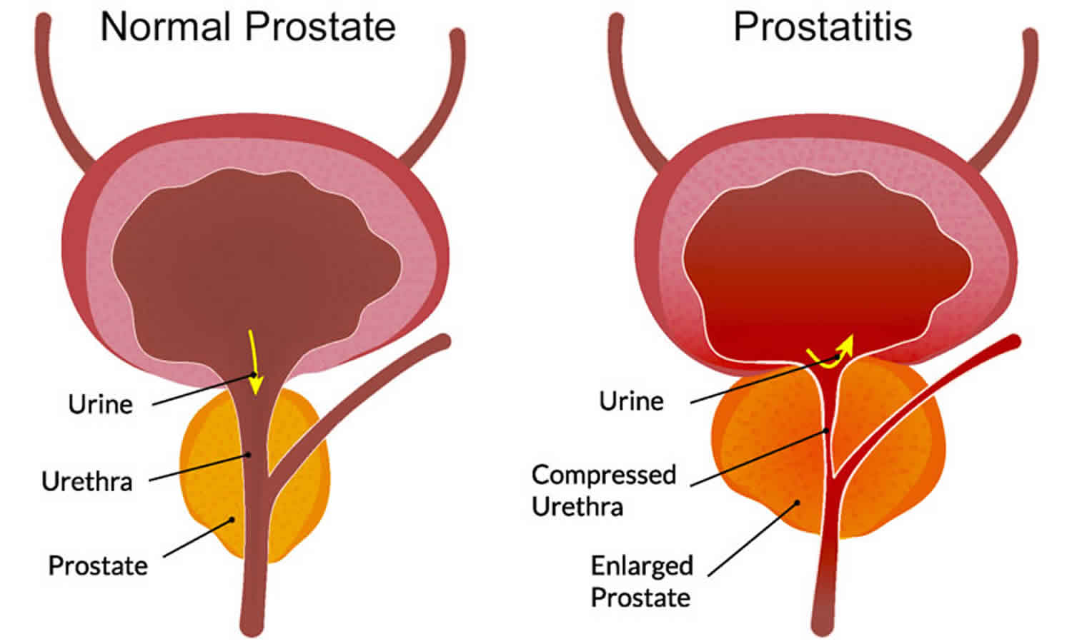 Acute prostatitis recovery time