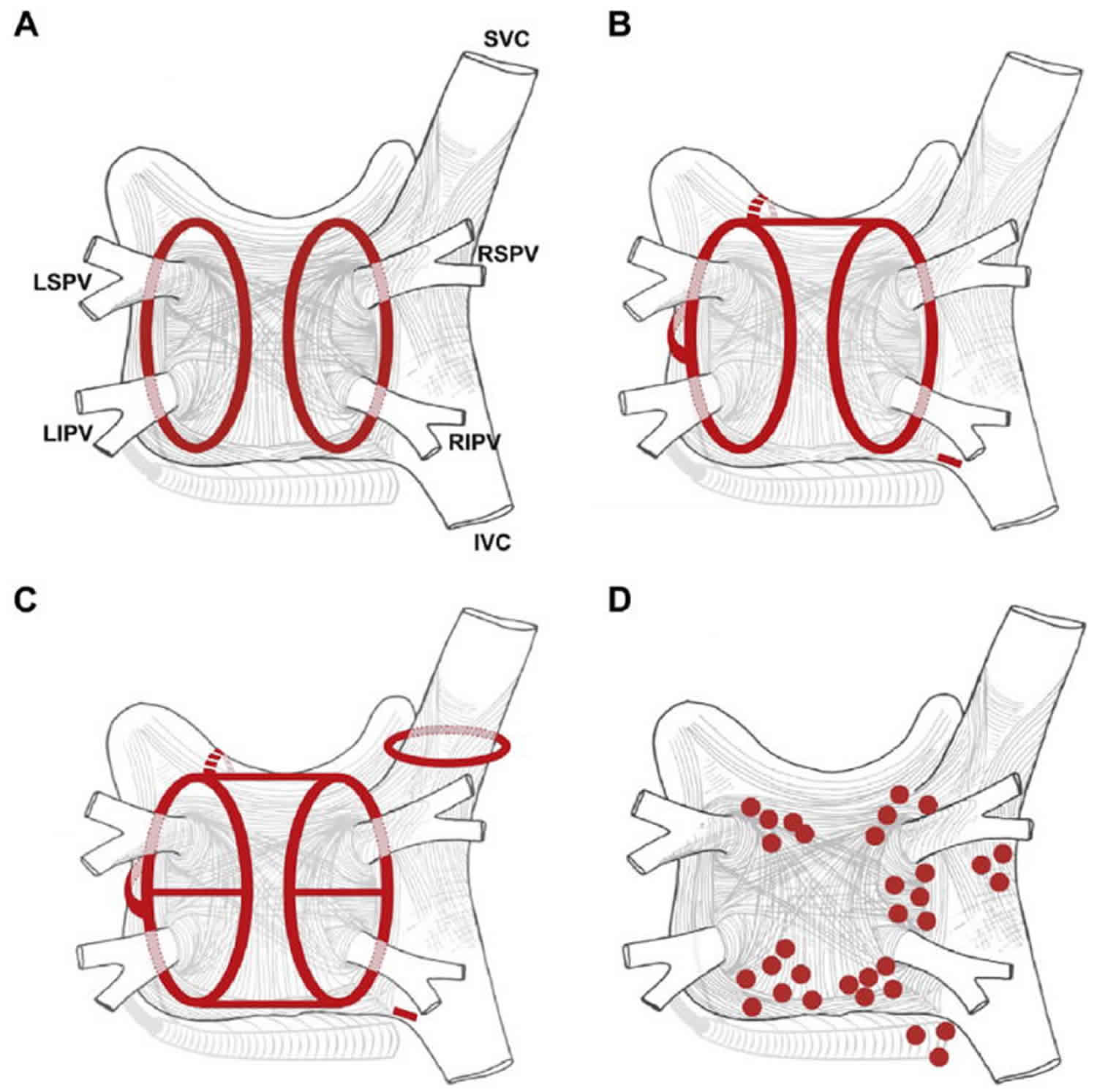 Pulmonary Vein Anatomy Function Location Ablation Stenosis And Thrombosis