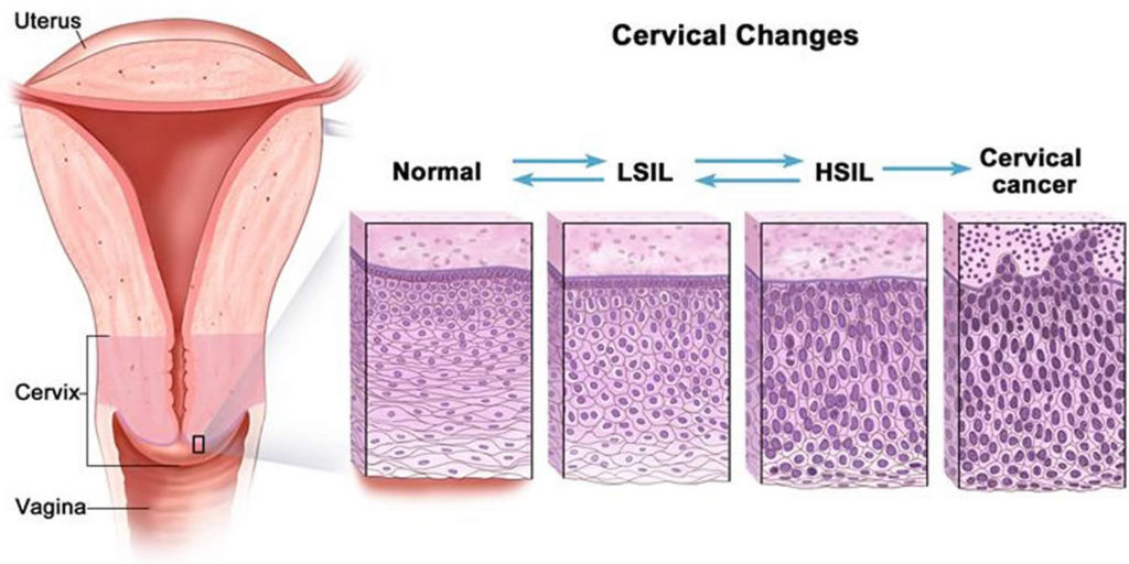 squamous-intraepithelial-lesion-low-grade-high-grade-symptoms