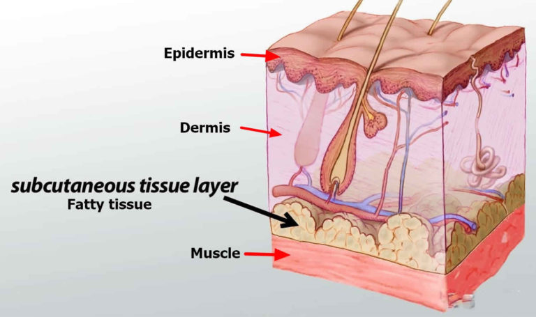 subcutaneous-injection-sites-how-to-give-subcutaneous-injection