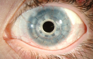 Cornea Transplant Types, Success Rate, Vision After Transplant 