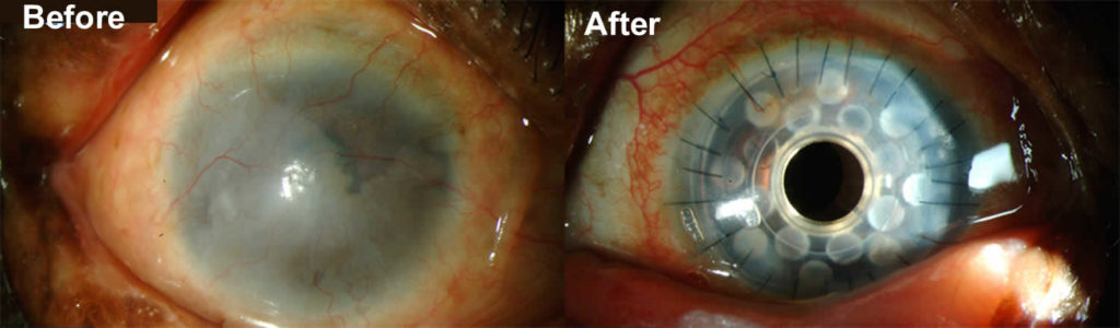 Cornea transplant types, success rate, vision after transplant ...