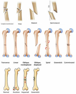 Broken femur types, causes, treatment, recovery time & complications