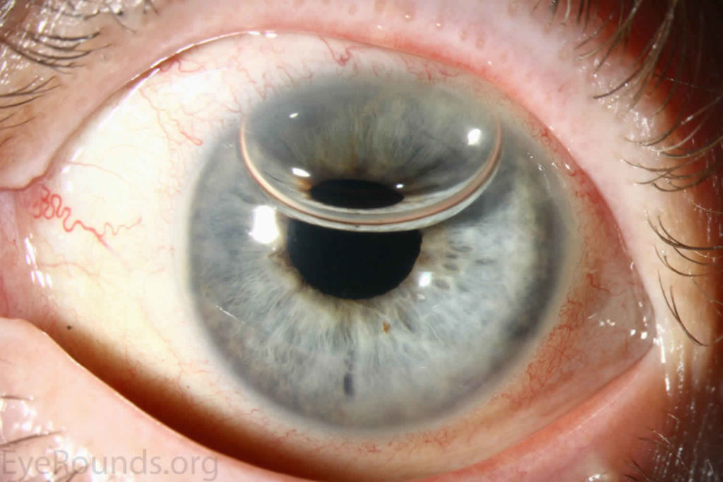 Cornea Transplant Types, Success Rate, Vision After Transplant ...