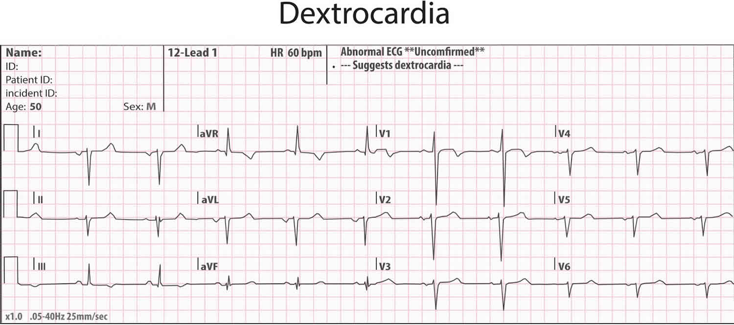 Dextrocardia Types, Dextrocardia Situs Inversus, Causes, Symptoms, Ecg 