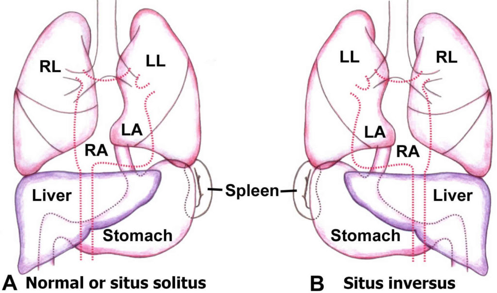 Dextrocardia types, dextrocardia situs inversus, causes, symptoms, ECG ...