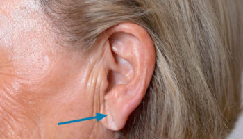 Ear lobe crease