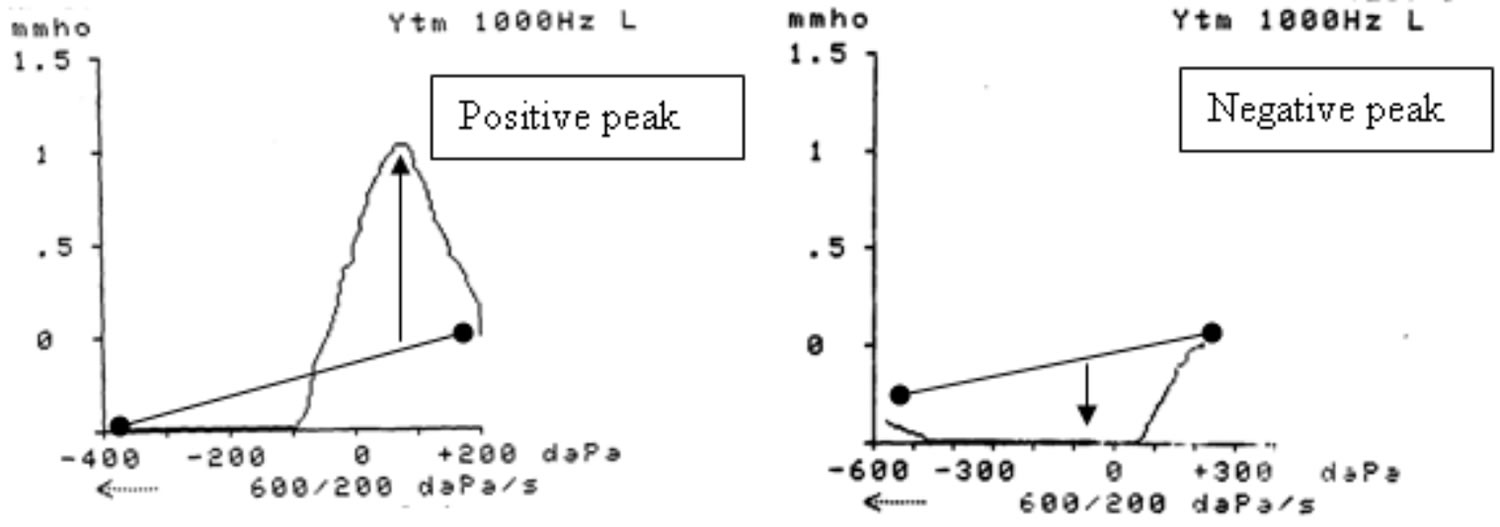 Tympanometry test, tympanometry types & abnormal tympanometry results