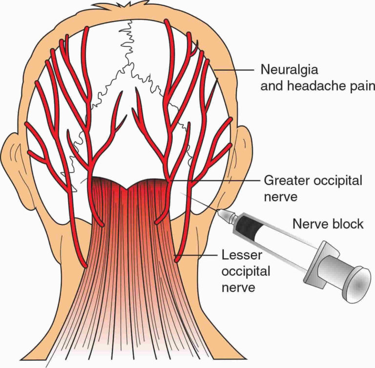 Nerve Block Uses Duration Nerve Block Procedure And Side Effects 2838