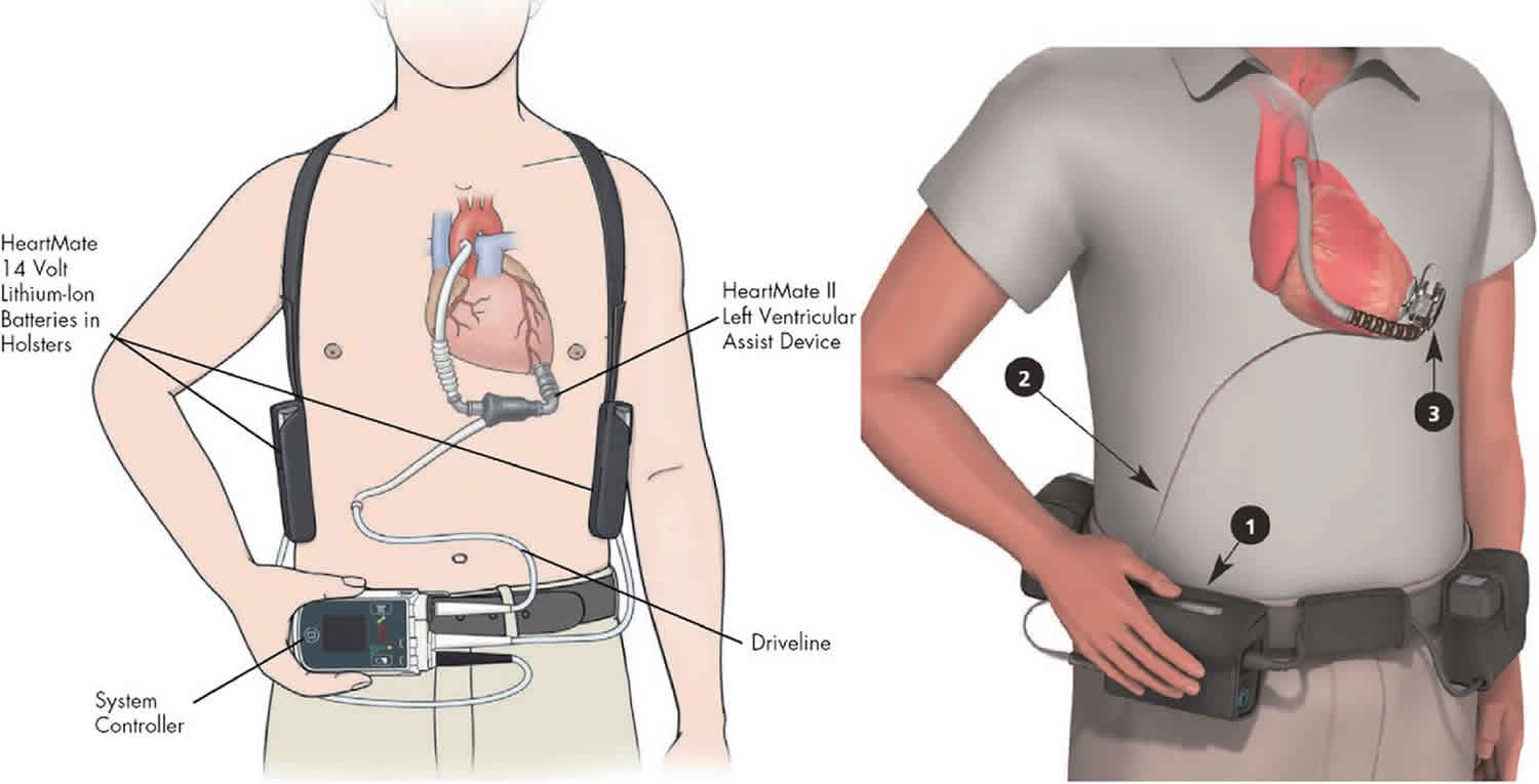 lvad-left-ventricular-assist-device-procedure-life-expectancy