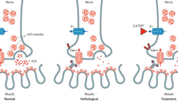 Lambert-Eaton syndrome
