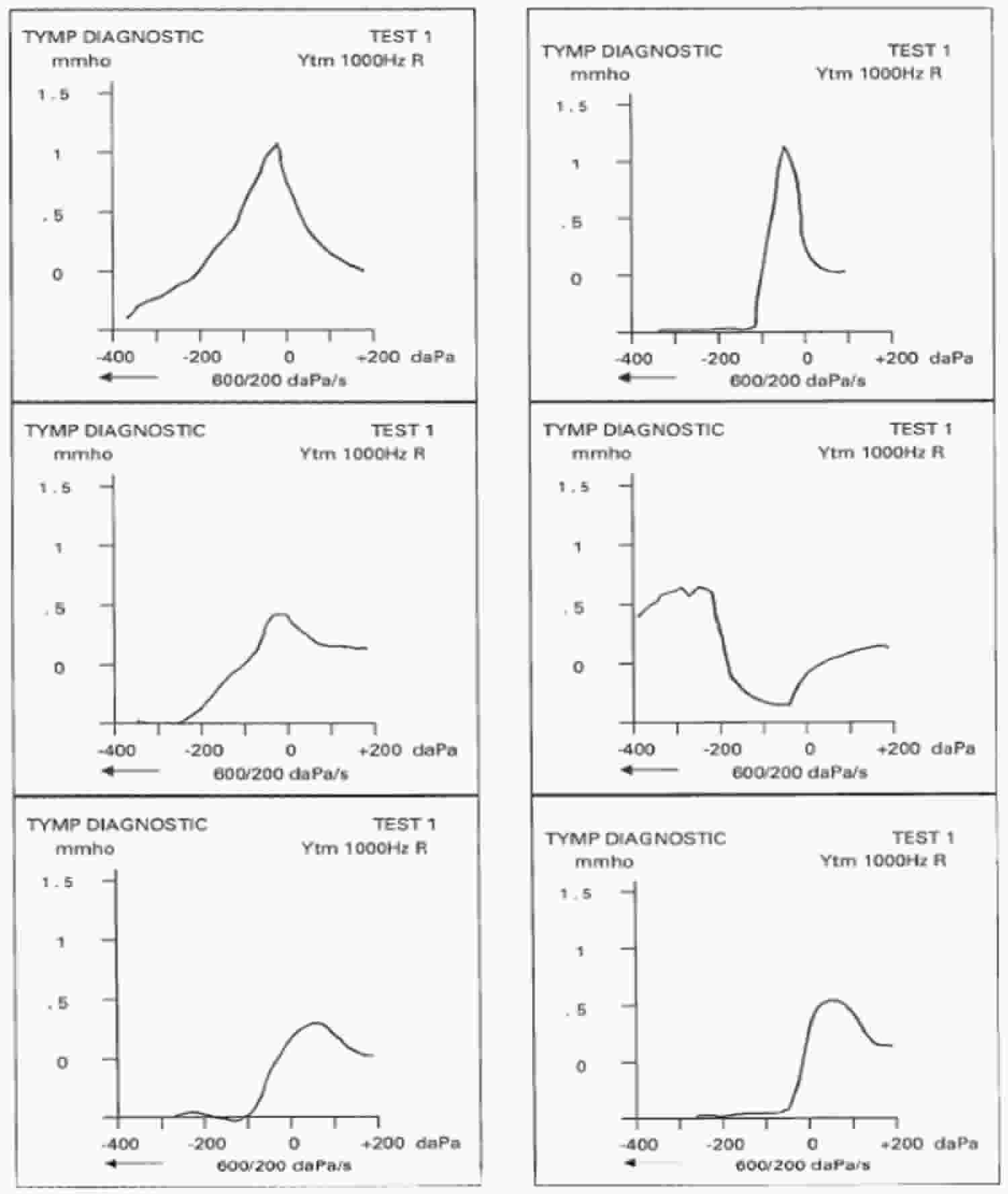 Tympanometry test, tympanometry types & abnormal tympanometry results