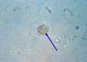 urine epithelial vesicle seminal