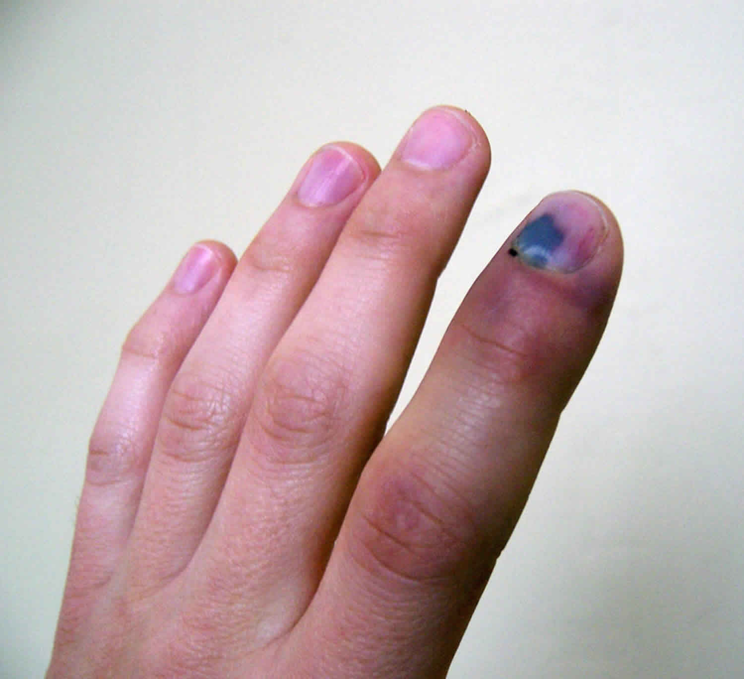 Jammed Finger May Be a Bigger Deal Than You Think - DrBadia.com