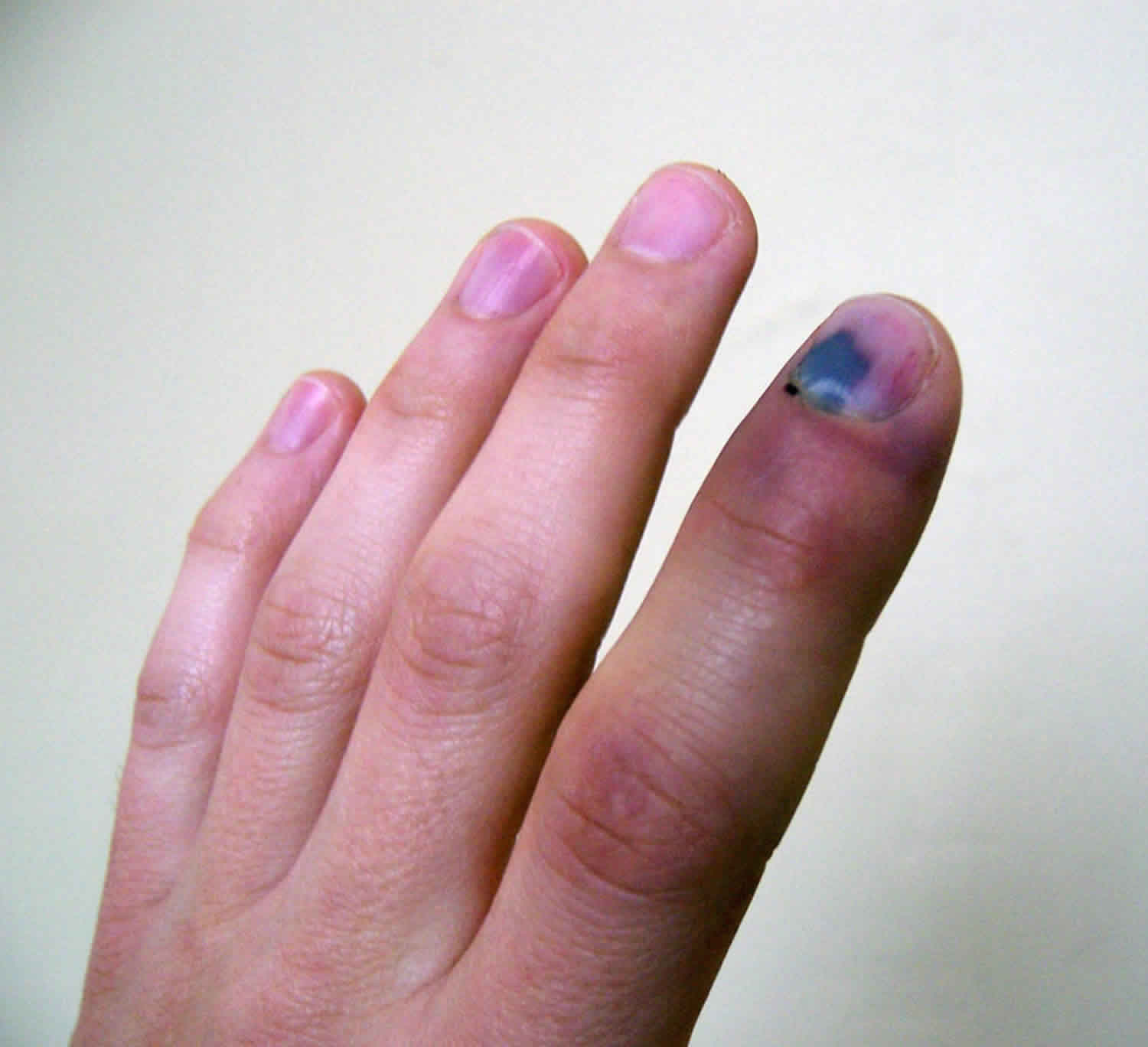 What swollen fingers may be telling you | YourLifeChoices