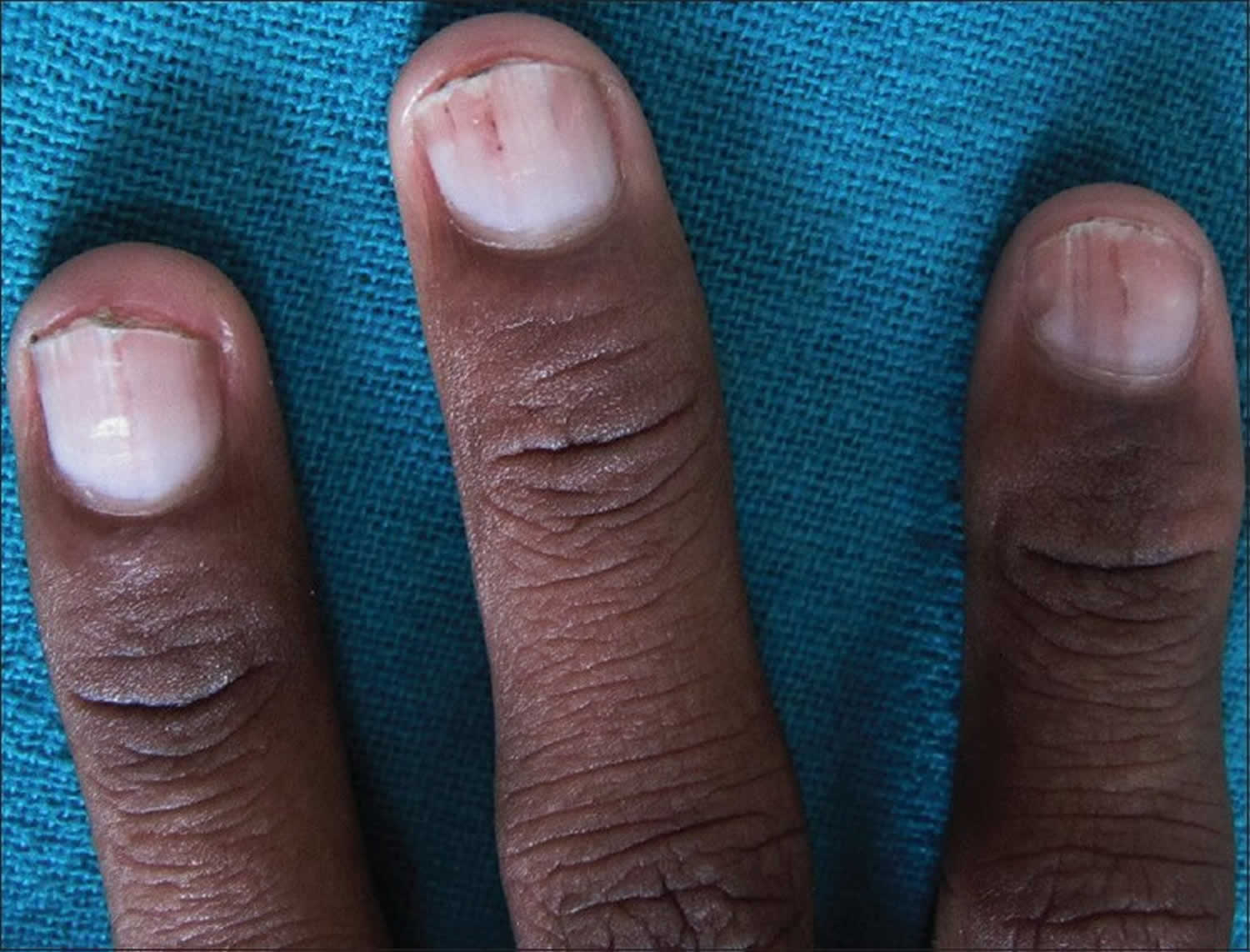 Janeway lesions, Osler nodes, splinter hemorrhages & Roth spots