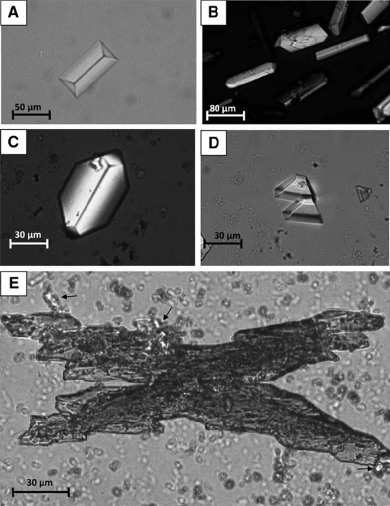 Crystals in urine cause, what does it mean to have crystals in urine