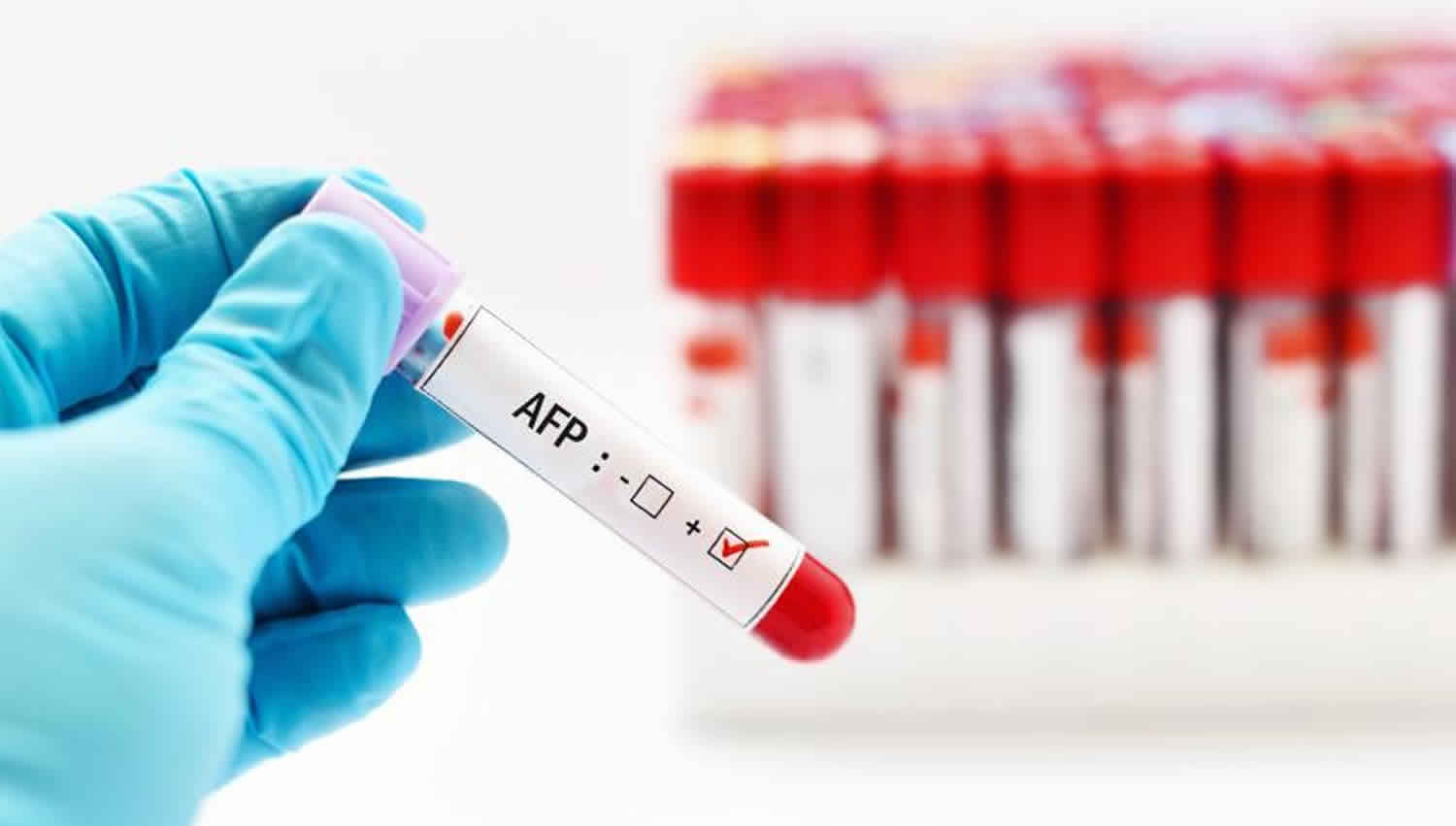 Alpha fetoprotein tumor marker & alpha fetoprotein