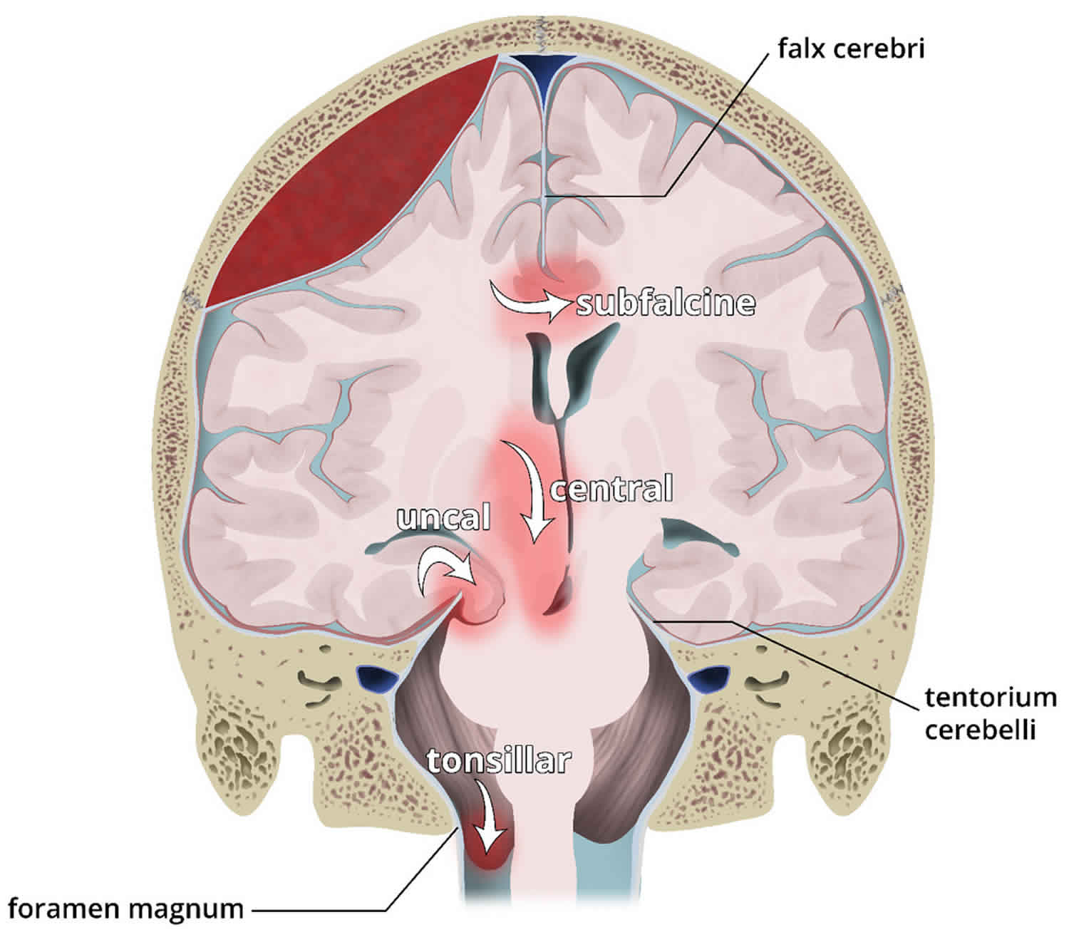 Brain herniation causes, types, signs, symptoms, prognosis and treatment