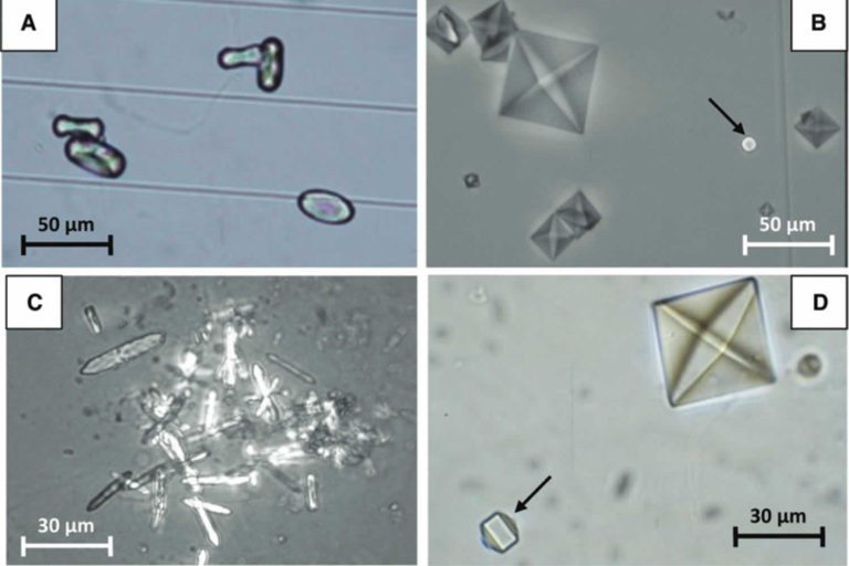 crystals-in-urine-cause-what-does-it-mean-to-have-crystals-in-urine