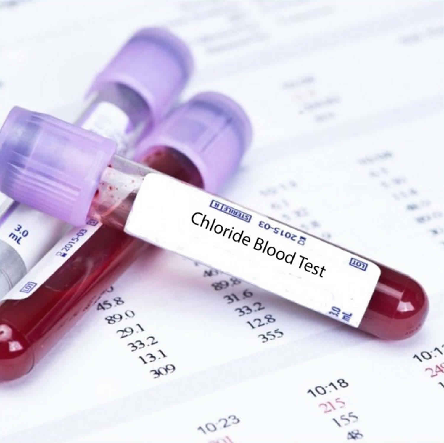 Chloride blood test, causes of high chloride or low chloride blood test