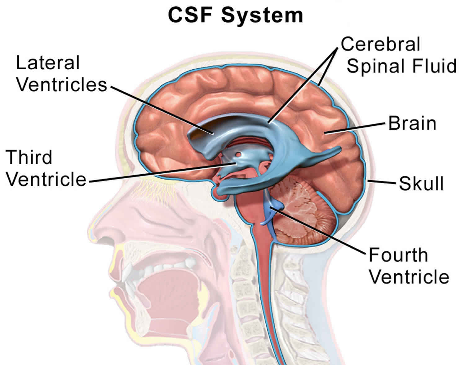 cerebrospinal fluid leak fever