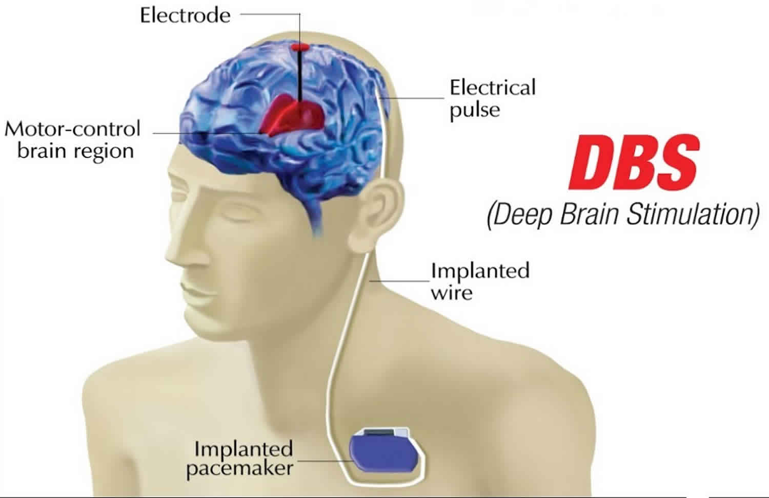 Deep Brain Stimulation Uses Success Rate And Side Effects
