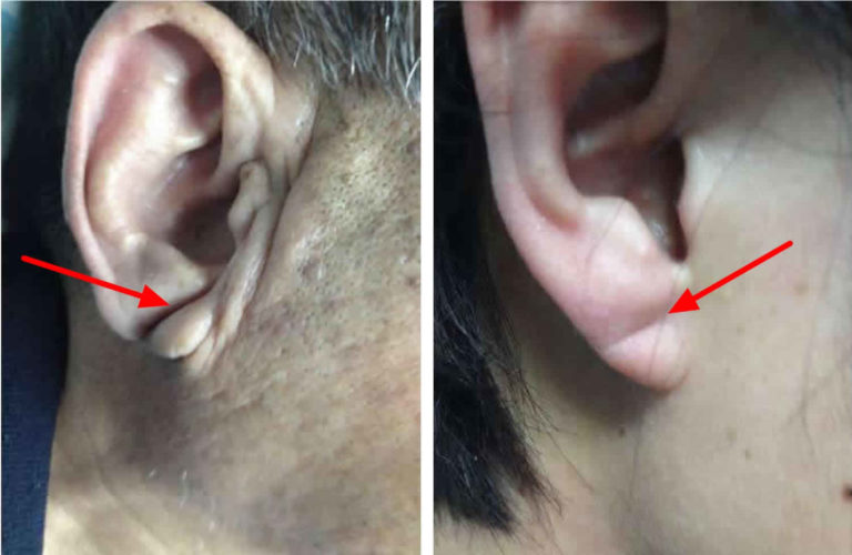 earlobe-crease-diagonal-earlobe-crease-and-heart-disease