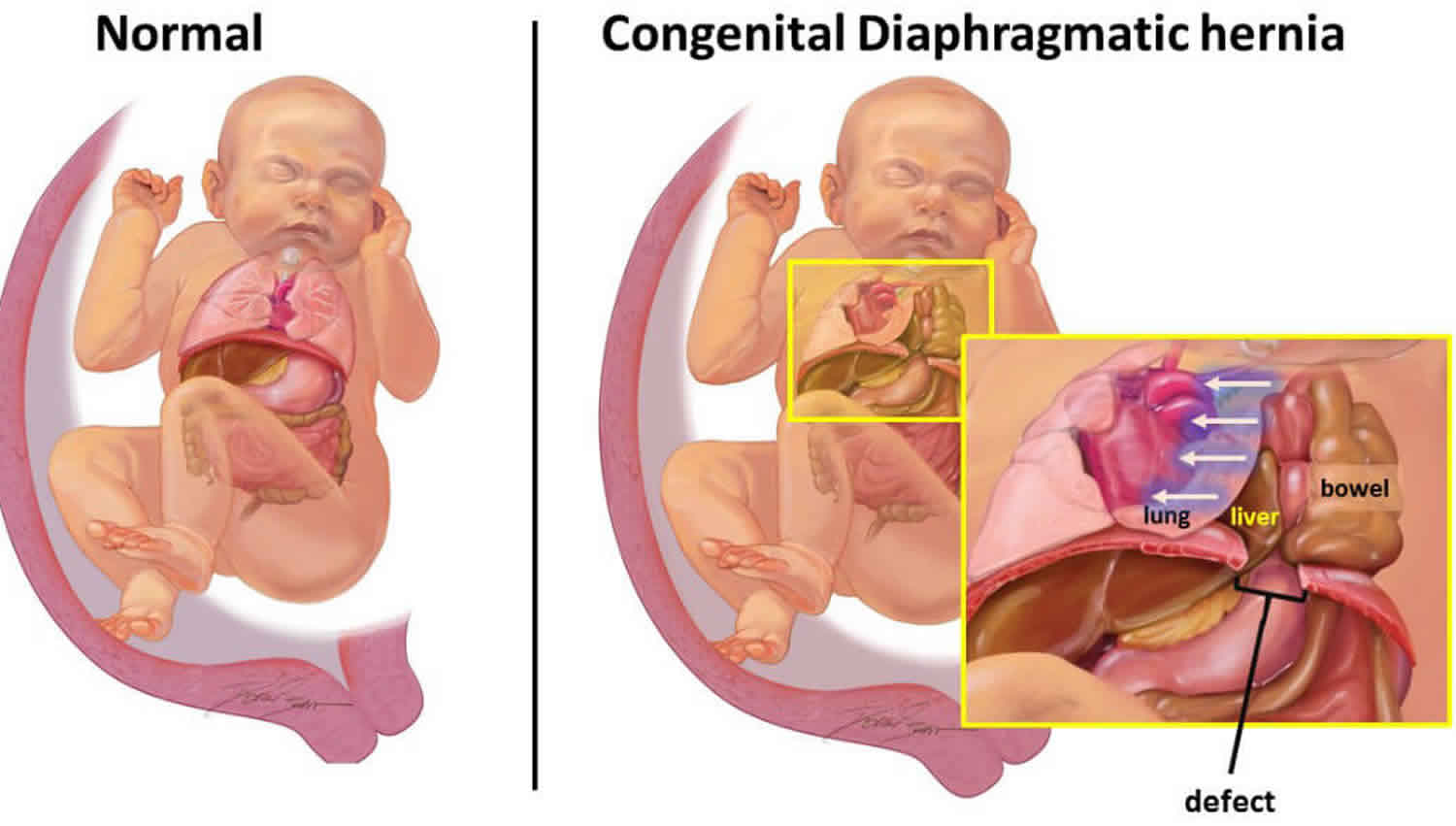 diaphragmatic hernia