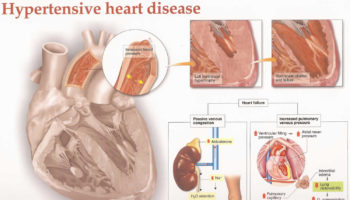 hypertensive heart disease