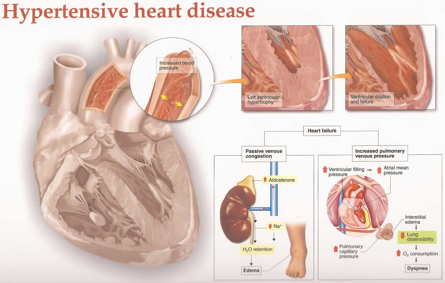 Hypertensive disease new arrivals