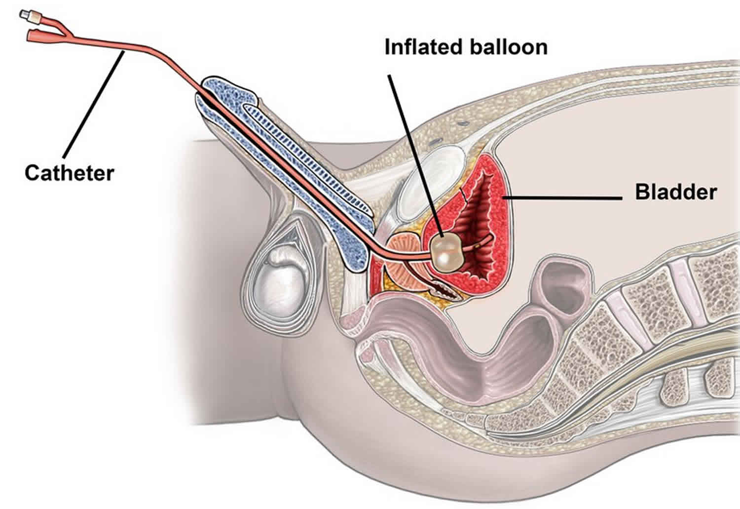 Indwelling Urinary Catheter Care Indwelling Catheter Insertion Complications