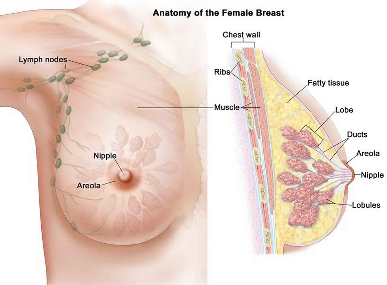papilloma benign breast tumor)