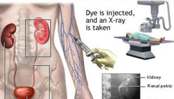 intravenous pyelogram