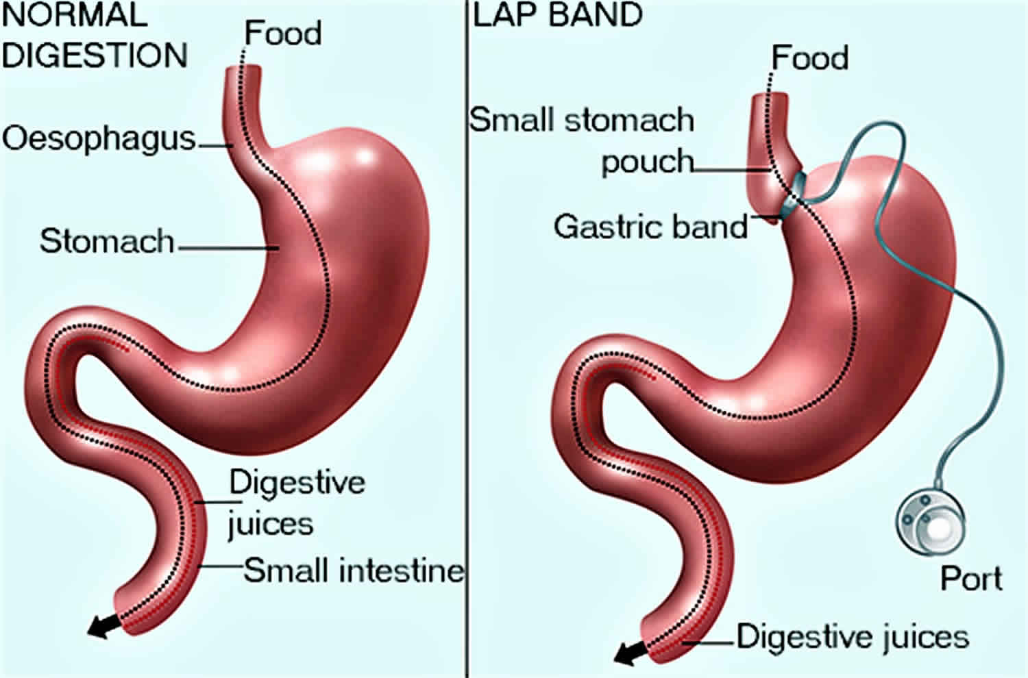 Lap band surgery, requirements, recovery time, risks, side effects & diet