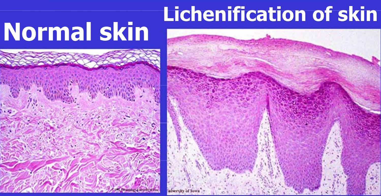 Lichenification of skin causes and how to get rid of lichenification