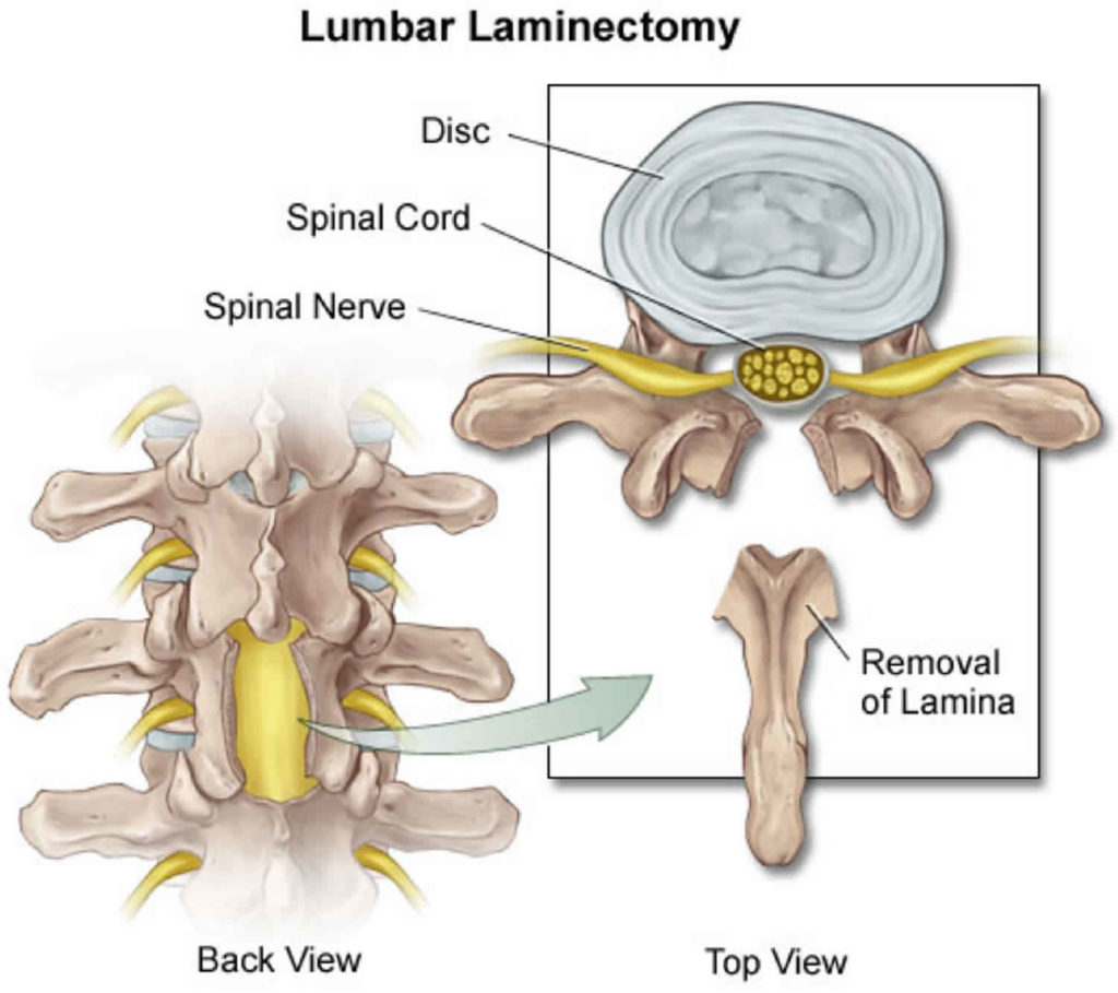 Back surgery, lower back surgery, indications, types, risks & complications