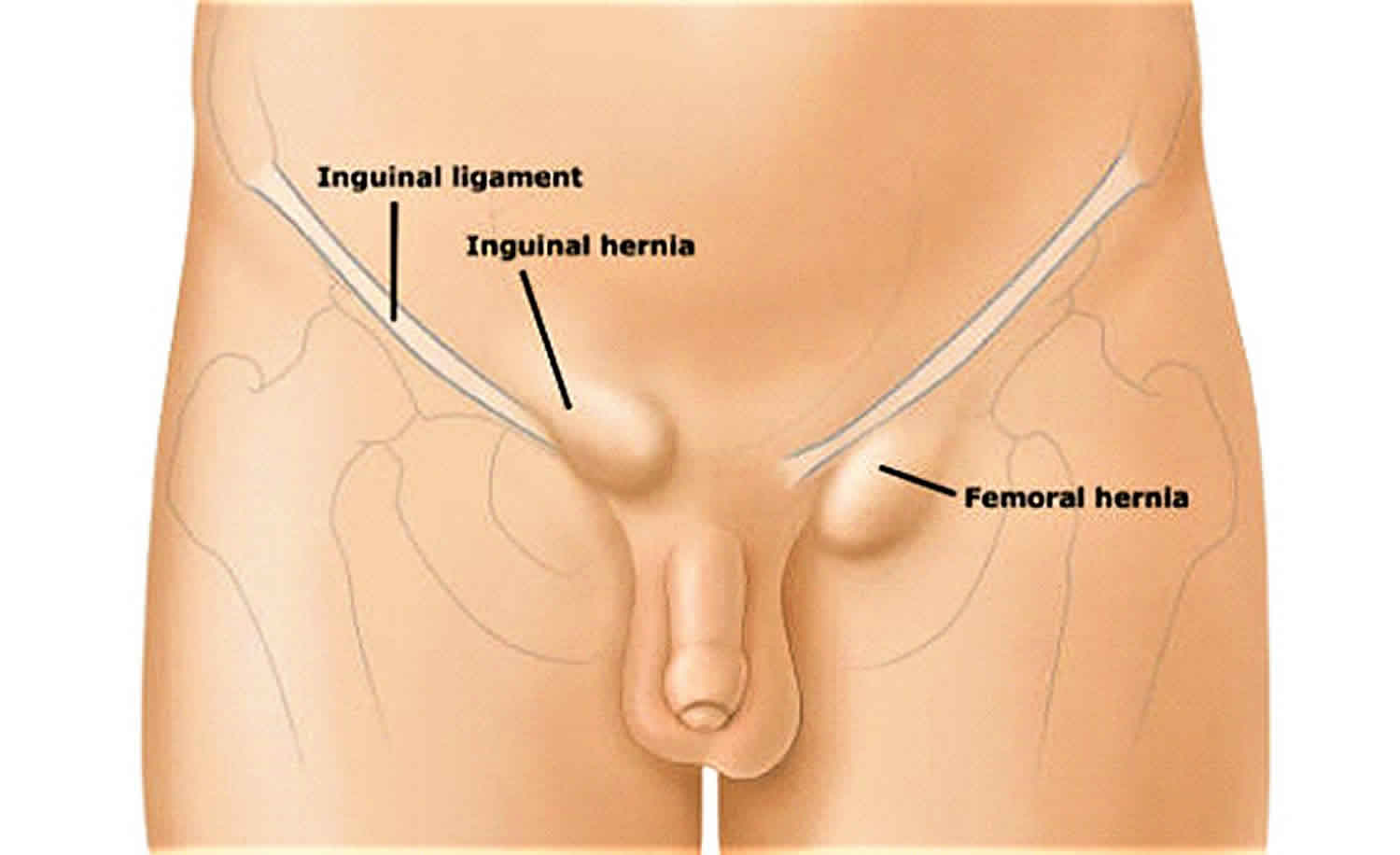 Lump in groin female and male, causes and diagnosis