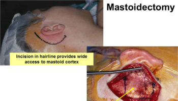 mastoidectomy