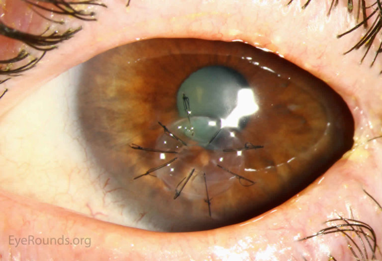 Cornea transplant types, success rate, vision after transplant