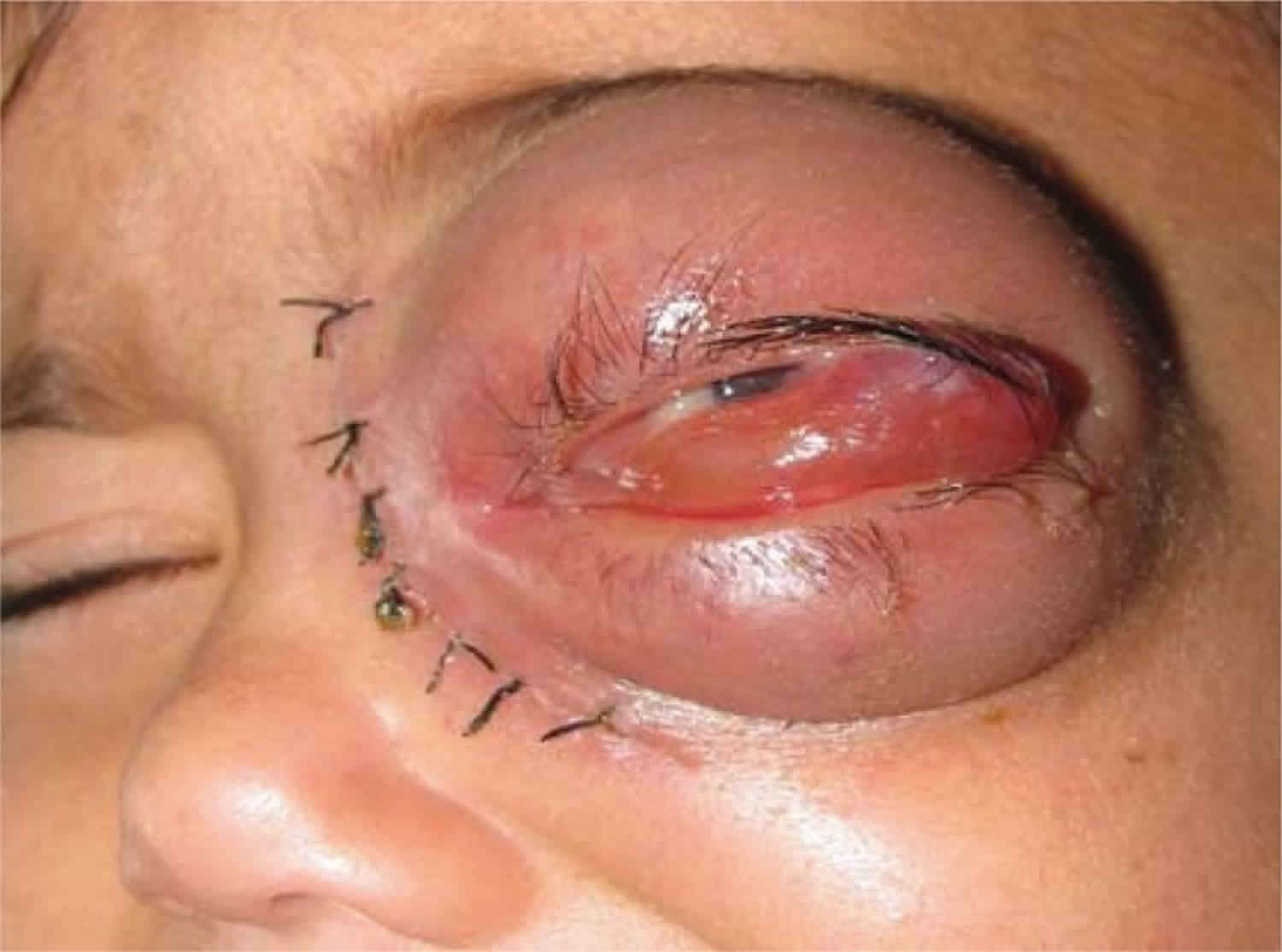 mucormycosis