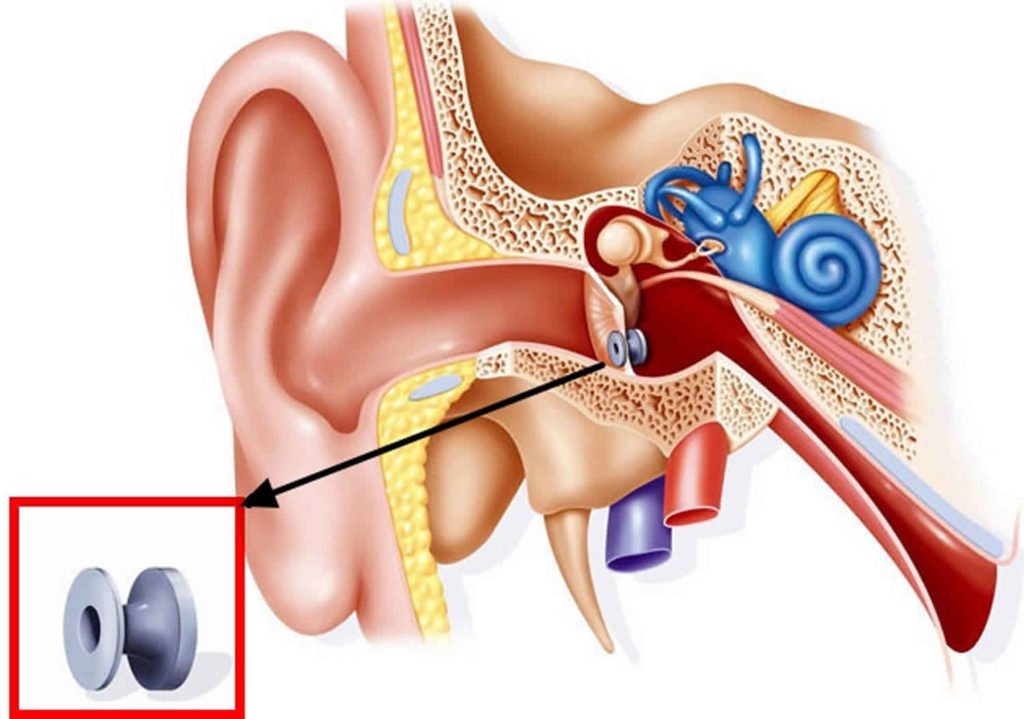 What Is Pe Tube Placement