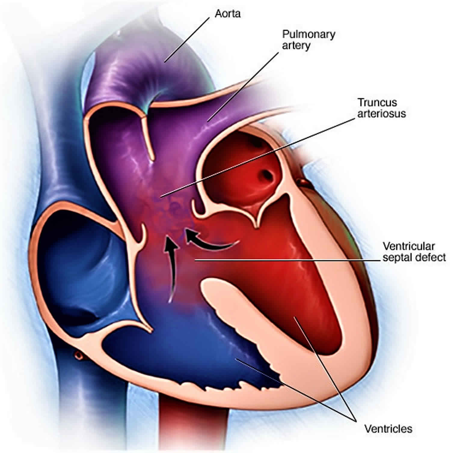 Truncus arteriosus causes, symptoms, diagnosis, treatment & prognosis