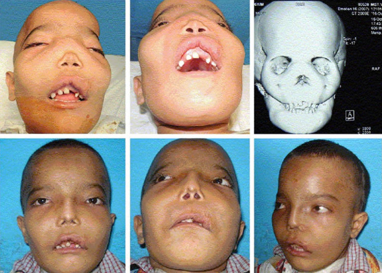 Fibrous dysplasia causes, symptoms, diagnosis, treatment & life expectancy