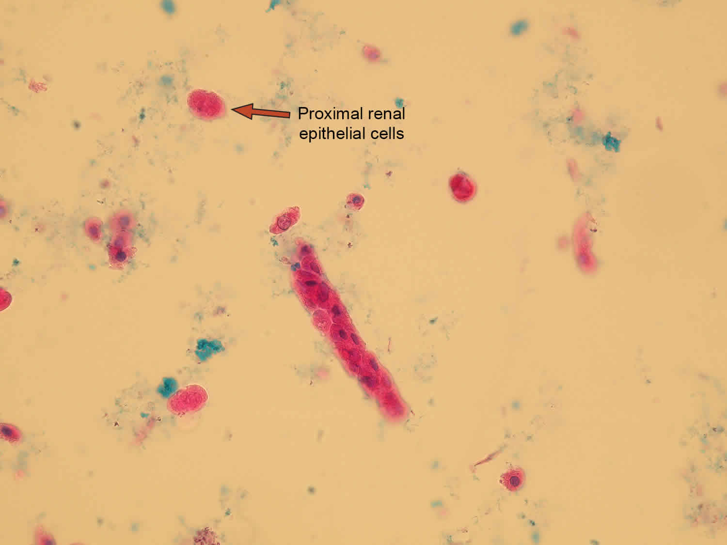 Epithelial Cells In Urine What Does It Mean If You Have Epithelial Cells In Urine