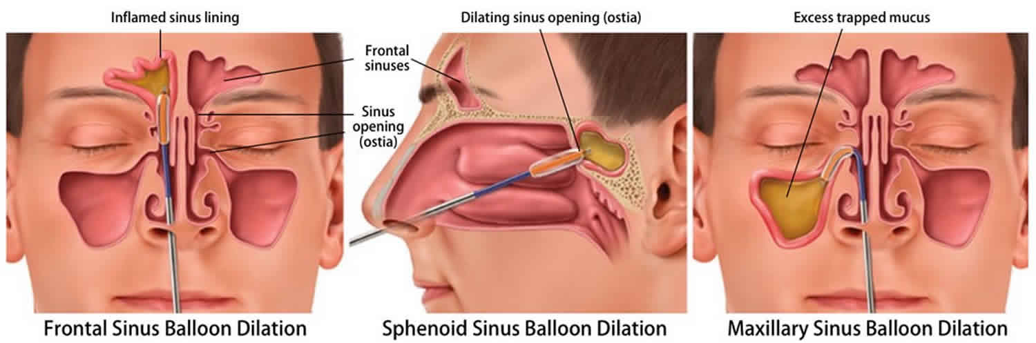Sinus Surgery Types Of Sinus Surgery Risks Sinus Surgery Recovery Time