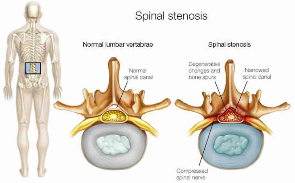 gabapentin lower back pain