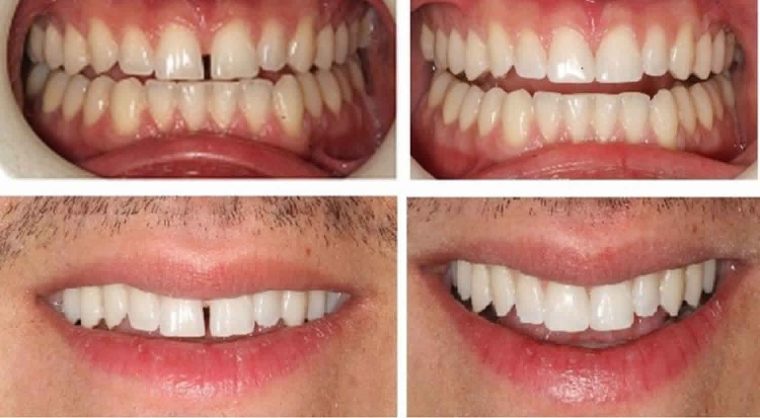 Advantages And Disadvantages Of Laser Teeth Lightening