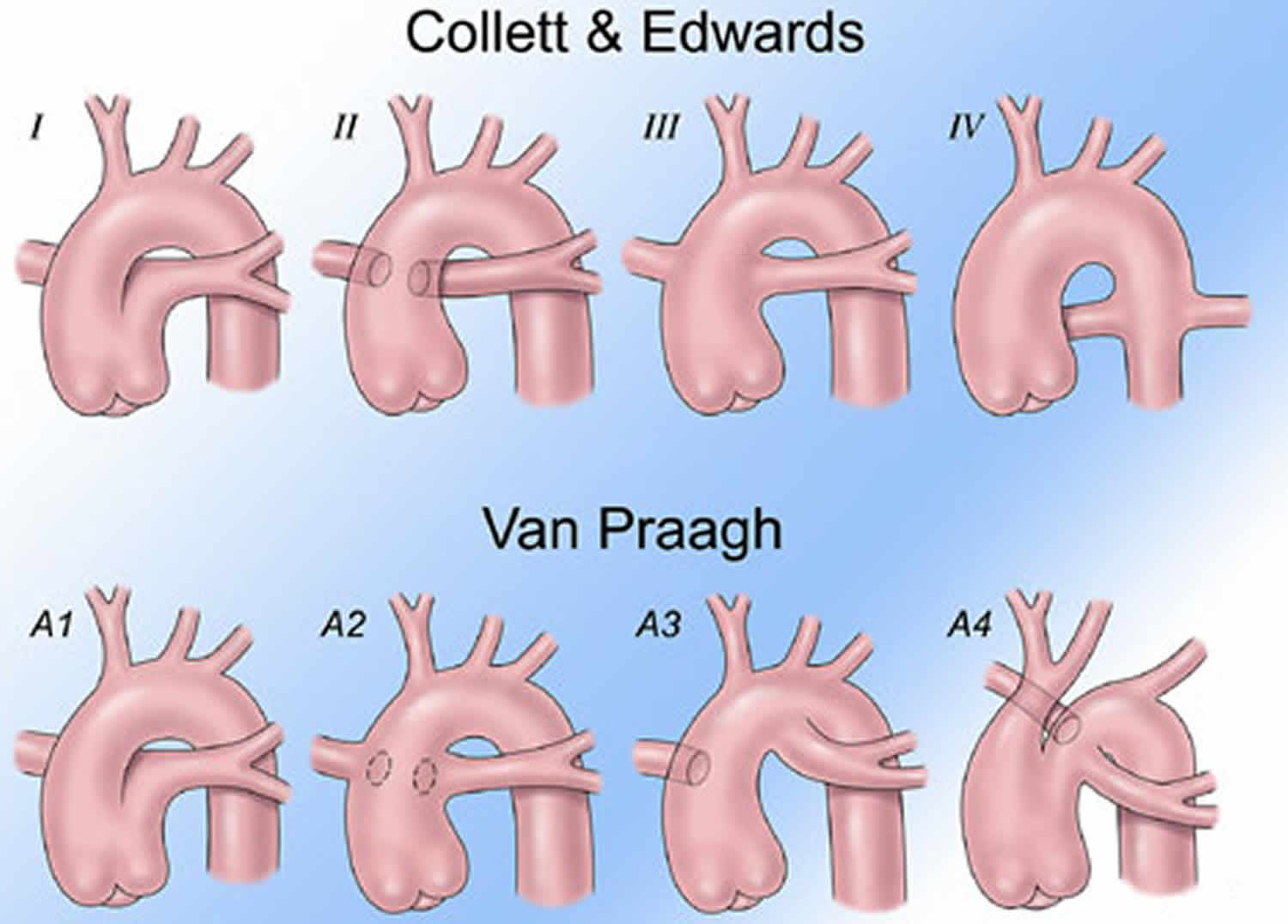 Truncus Arteriosus Causes Symptoms Diagnosis Treatment And Prognosis