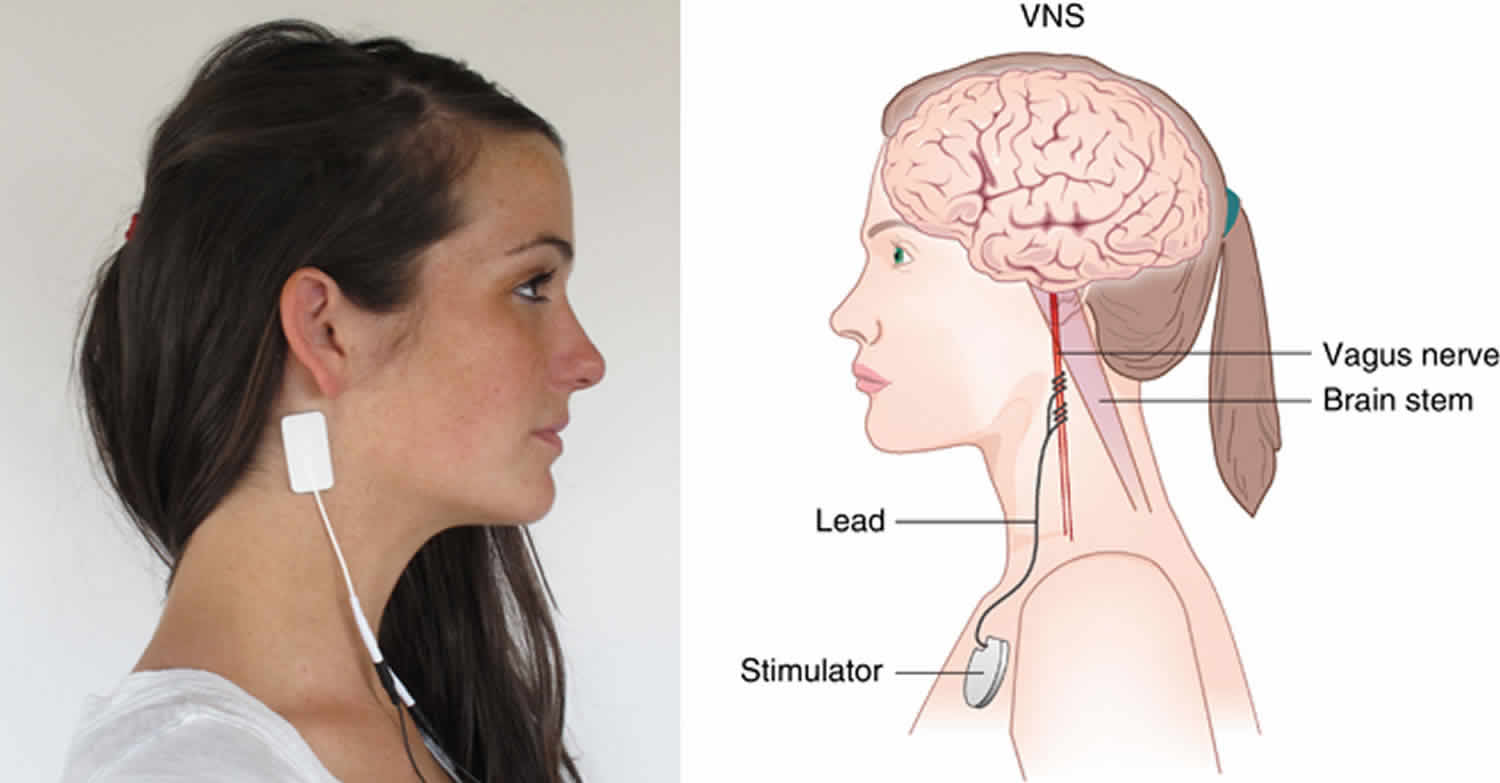 vagus-nerve-stimulation-vagus-nerve-stimulation-therapy-uses-side